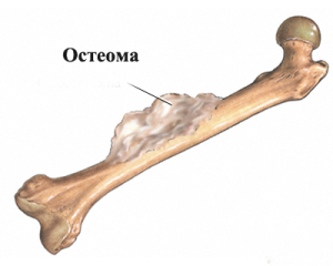 остеома